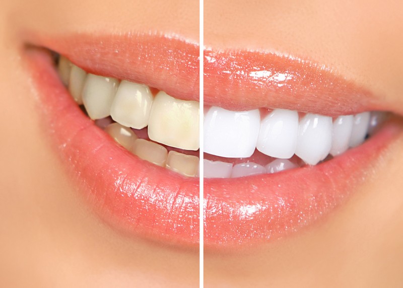 Teeth Whitening  Albany, NY -